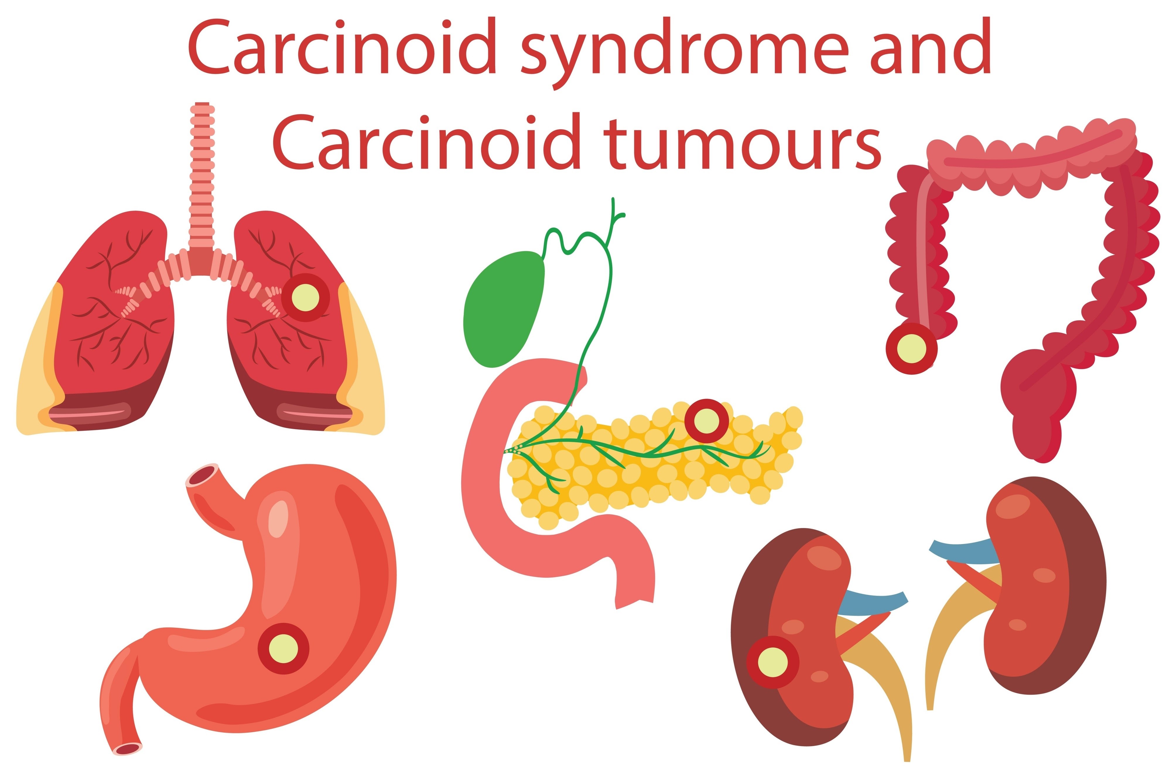 CARCINOID TUMOR