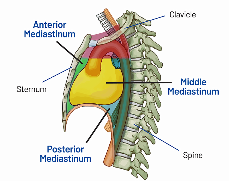 MEDIASTINAL TUMOR