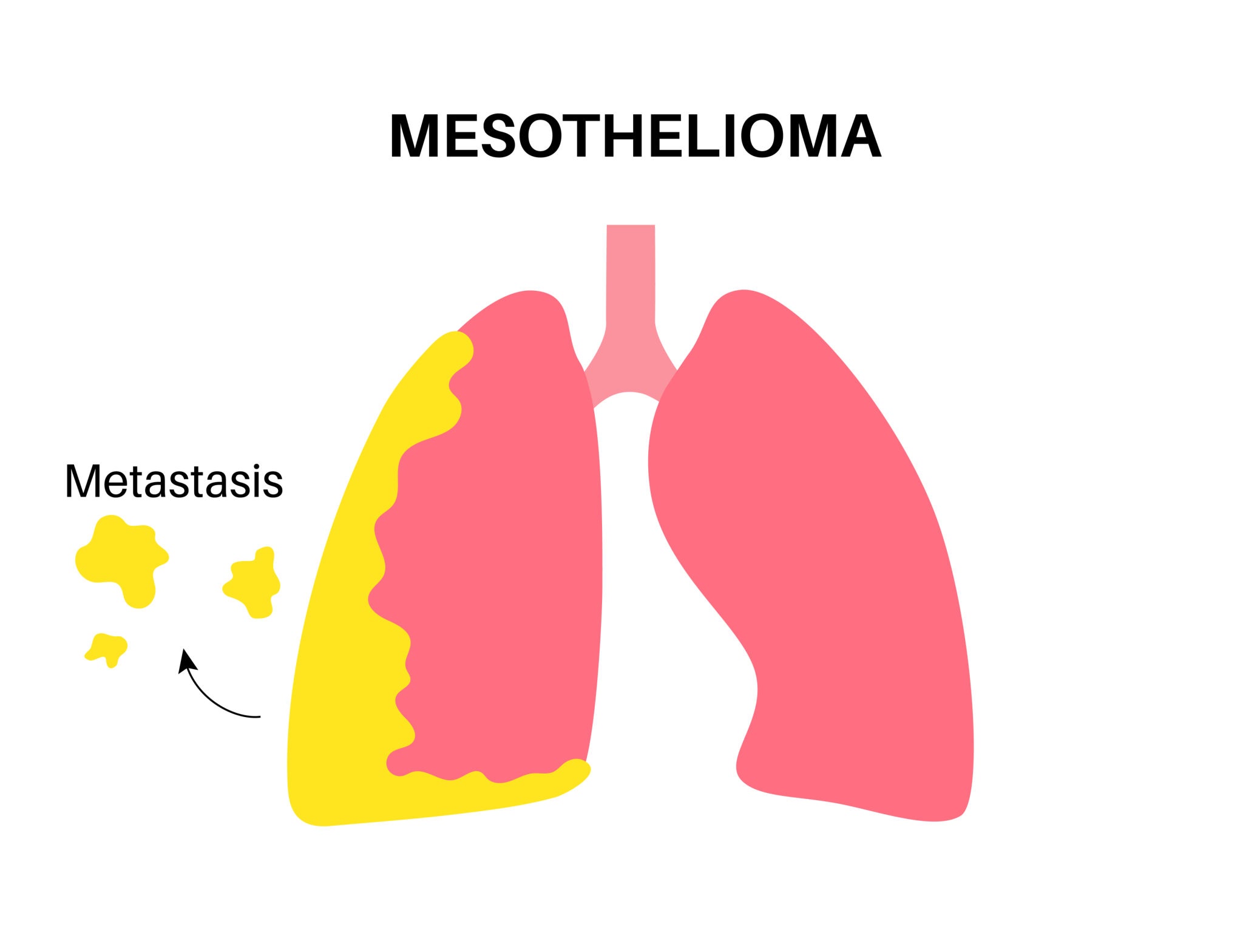 MESOTHELIOMA