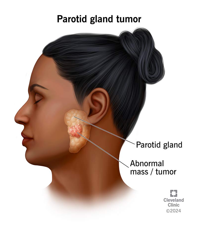 Parotid Cancer