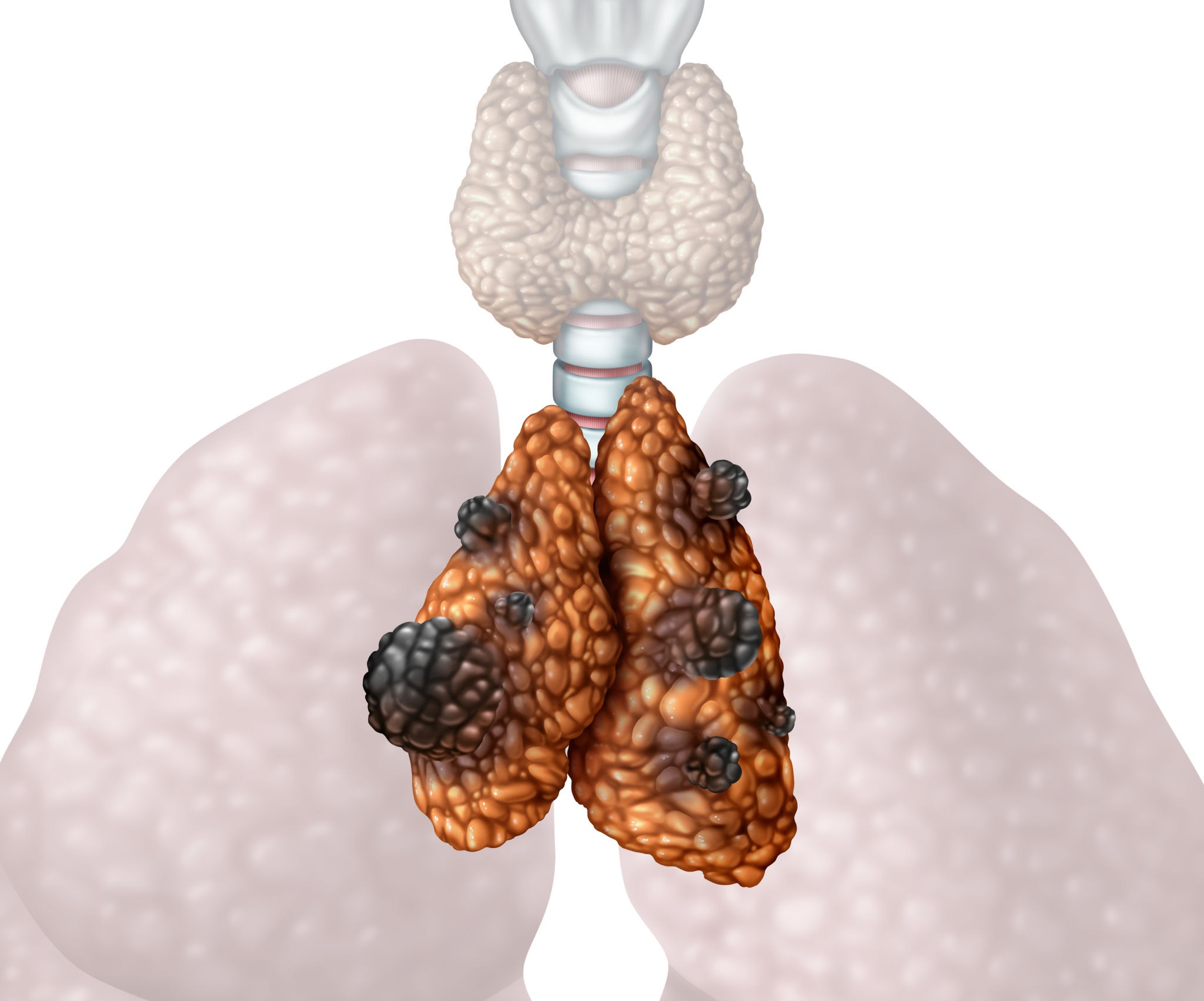 THYMIC CANCER