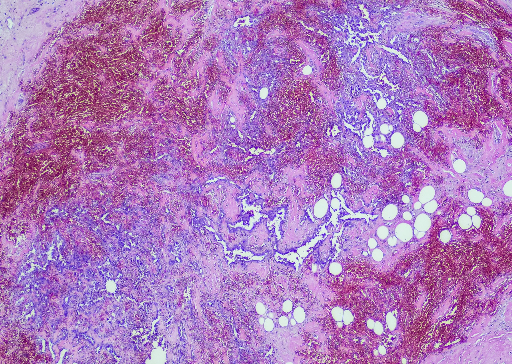 Angiosarcoma