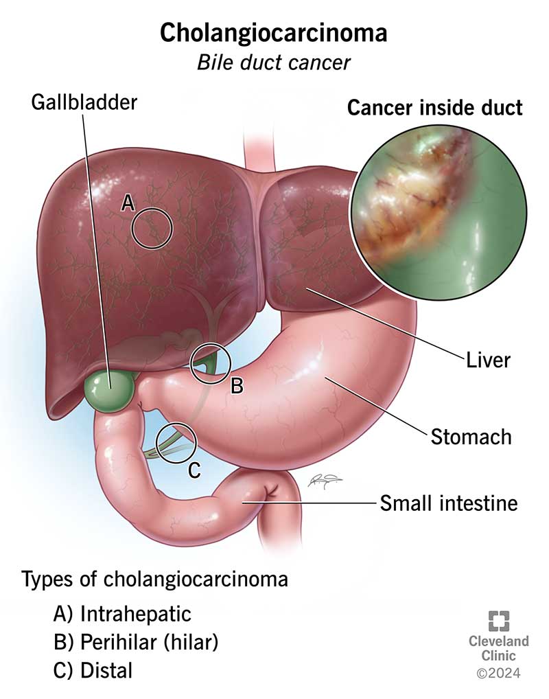 Bile Duct Cancer (Cholangiocarcinoma)