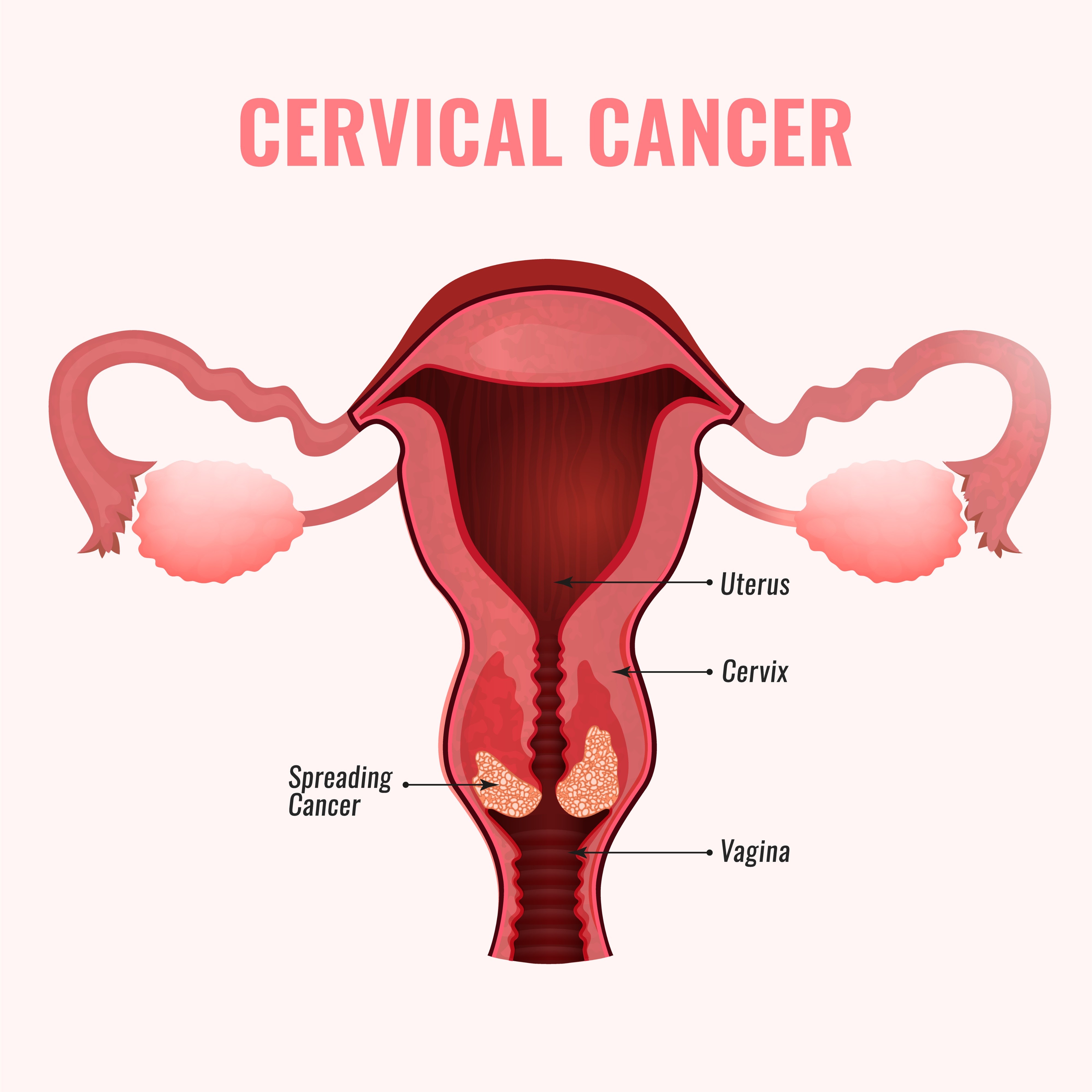 Cervical Cancer