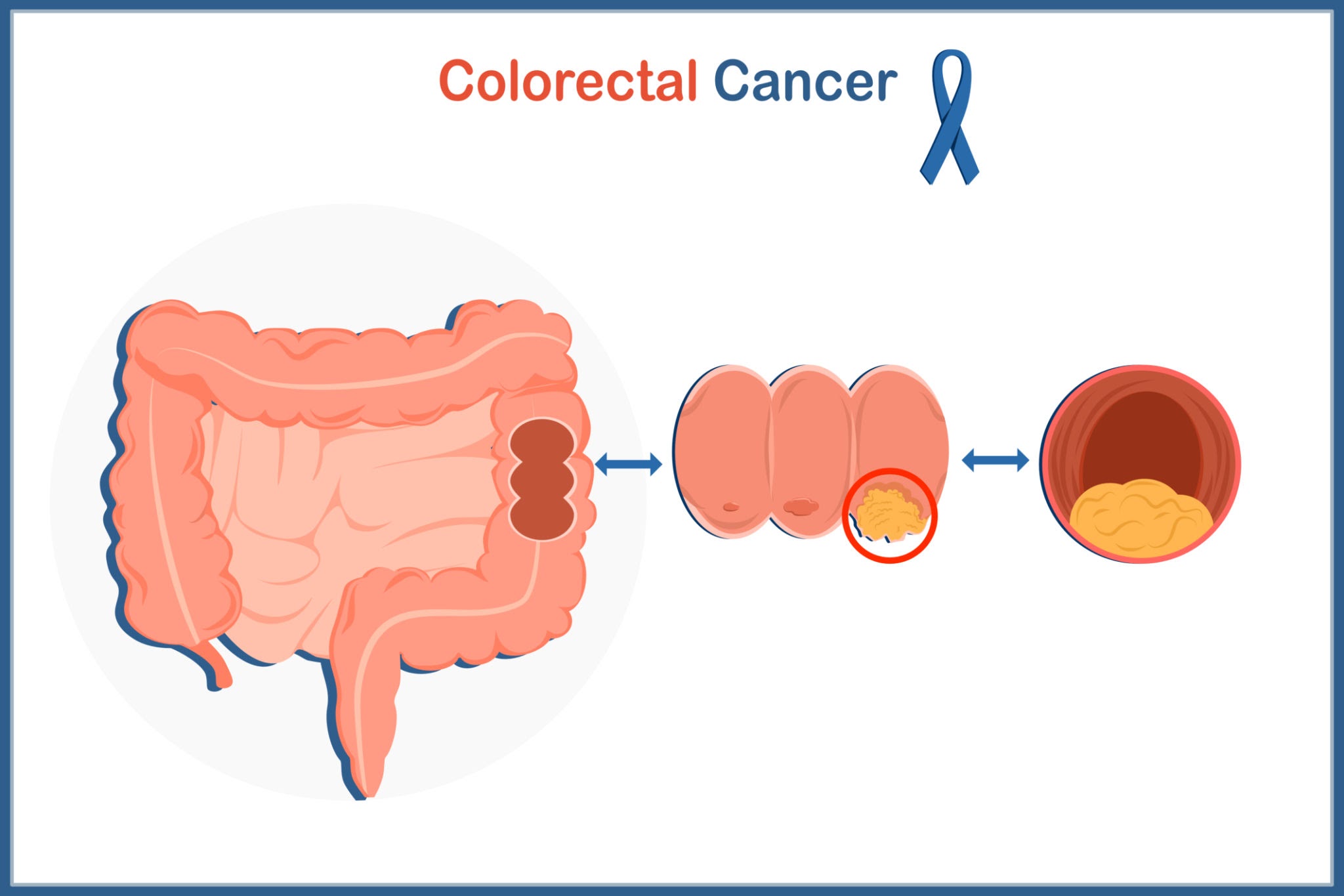 Colorectal Cancer