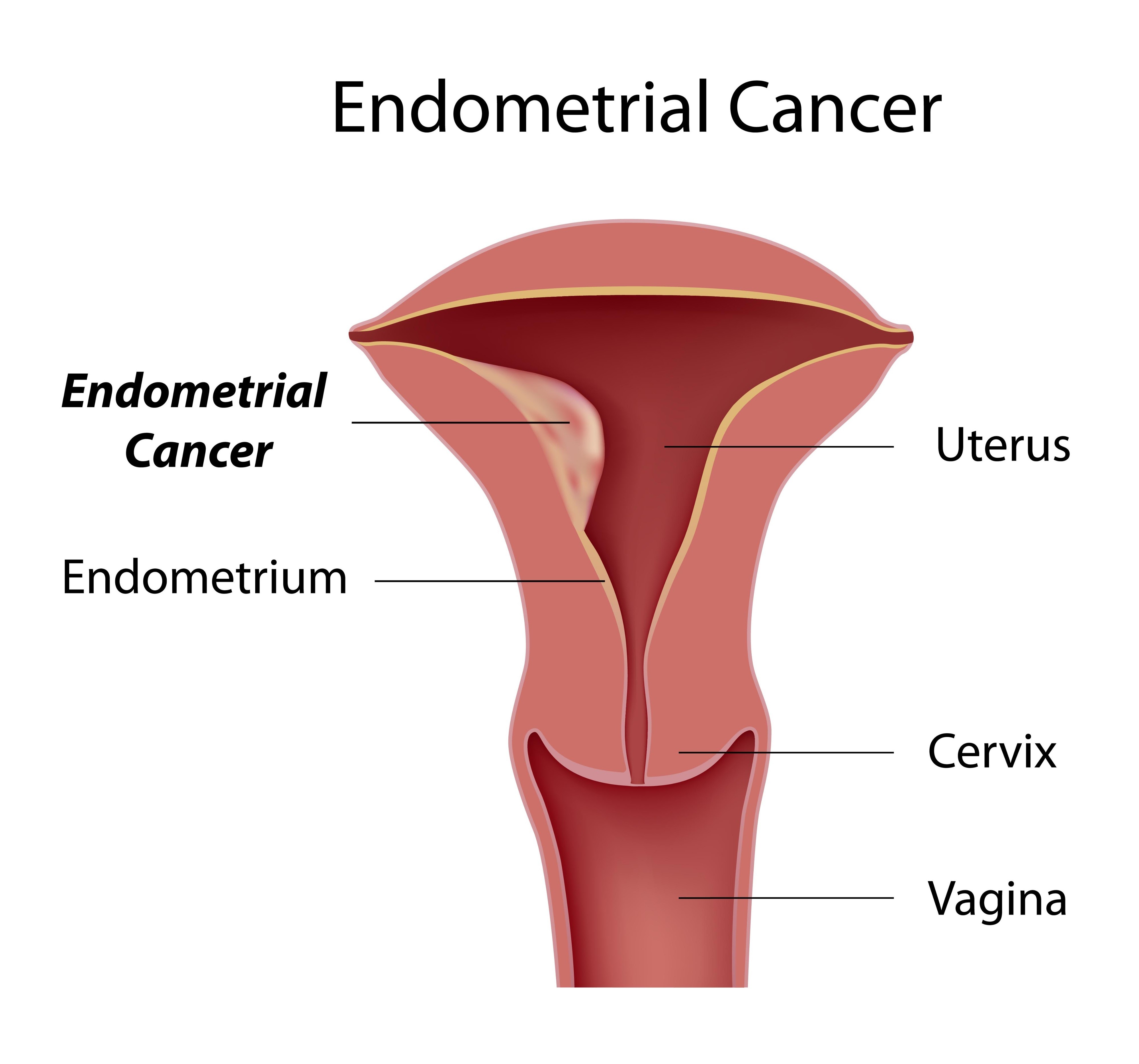 Endometrial (Uterine) Cancer