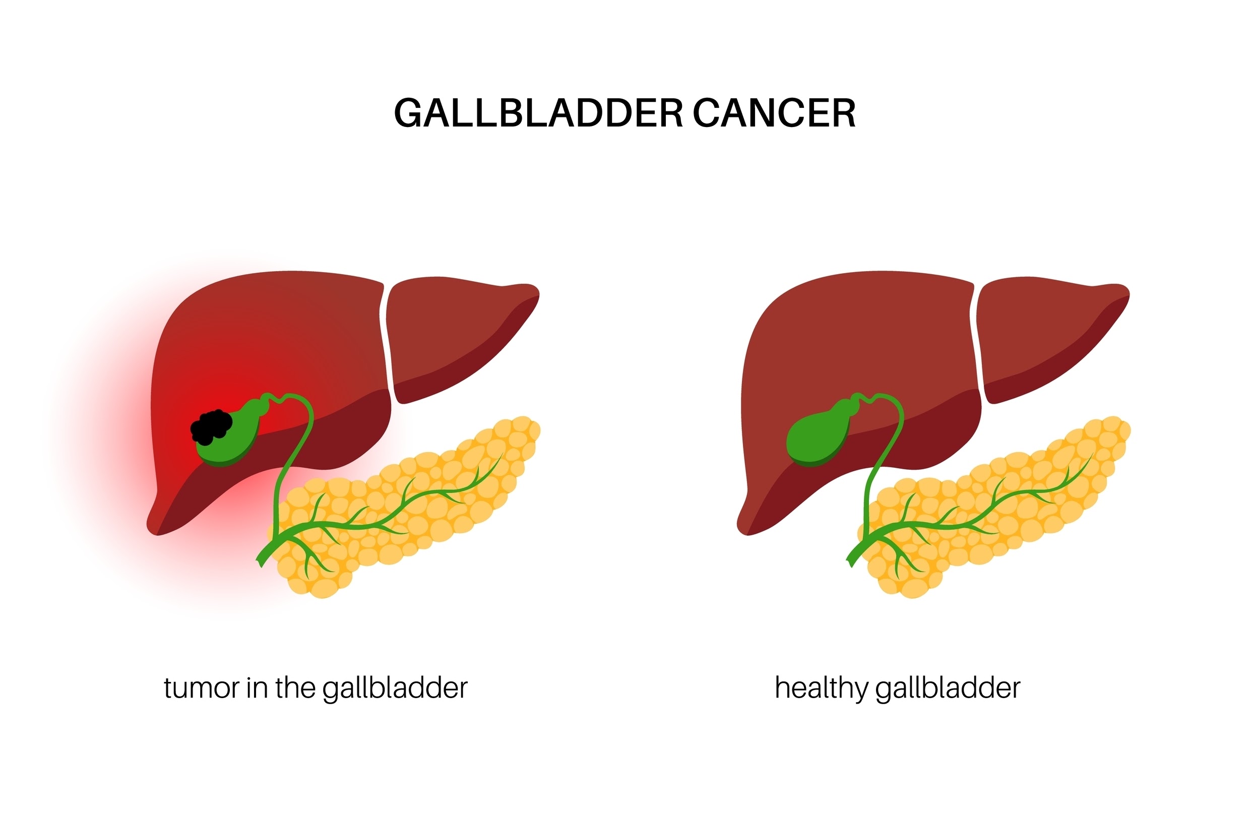 Gallbladder Cancer