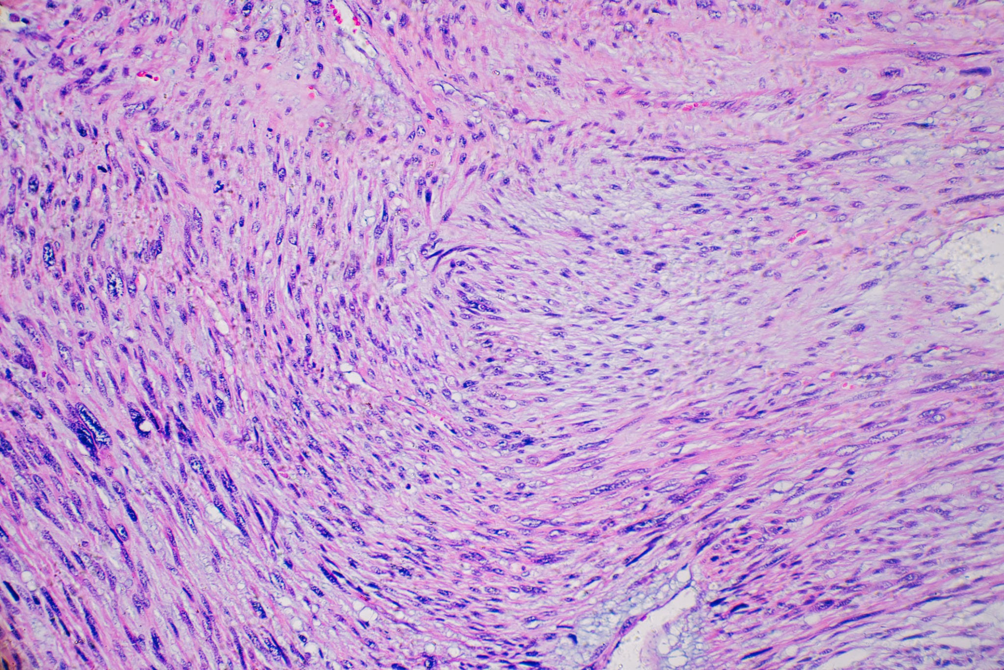 Leiomyosarcoma