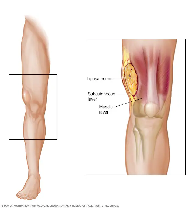 Liposarcoma