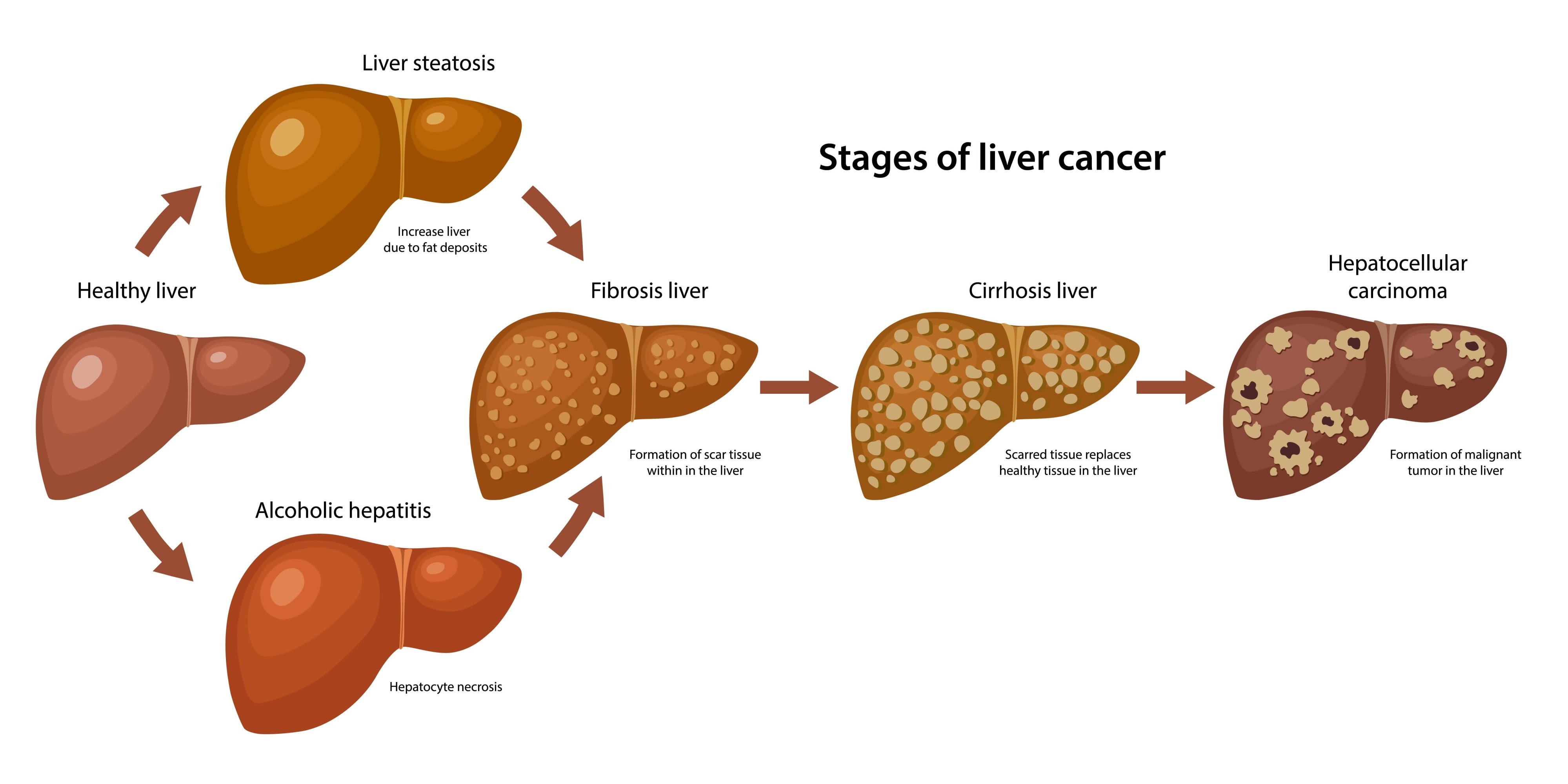 Liver Cancer (Hepatocellular Carcinoma)