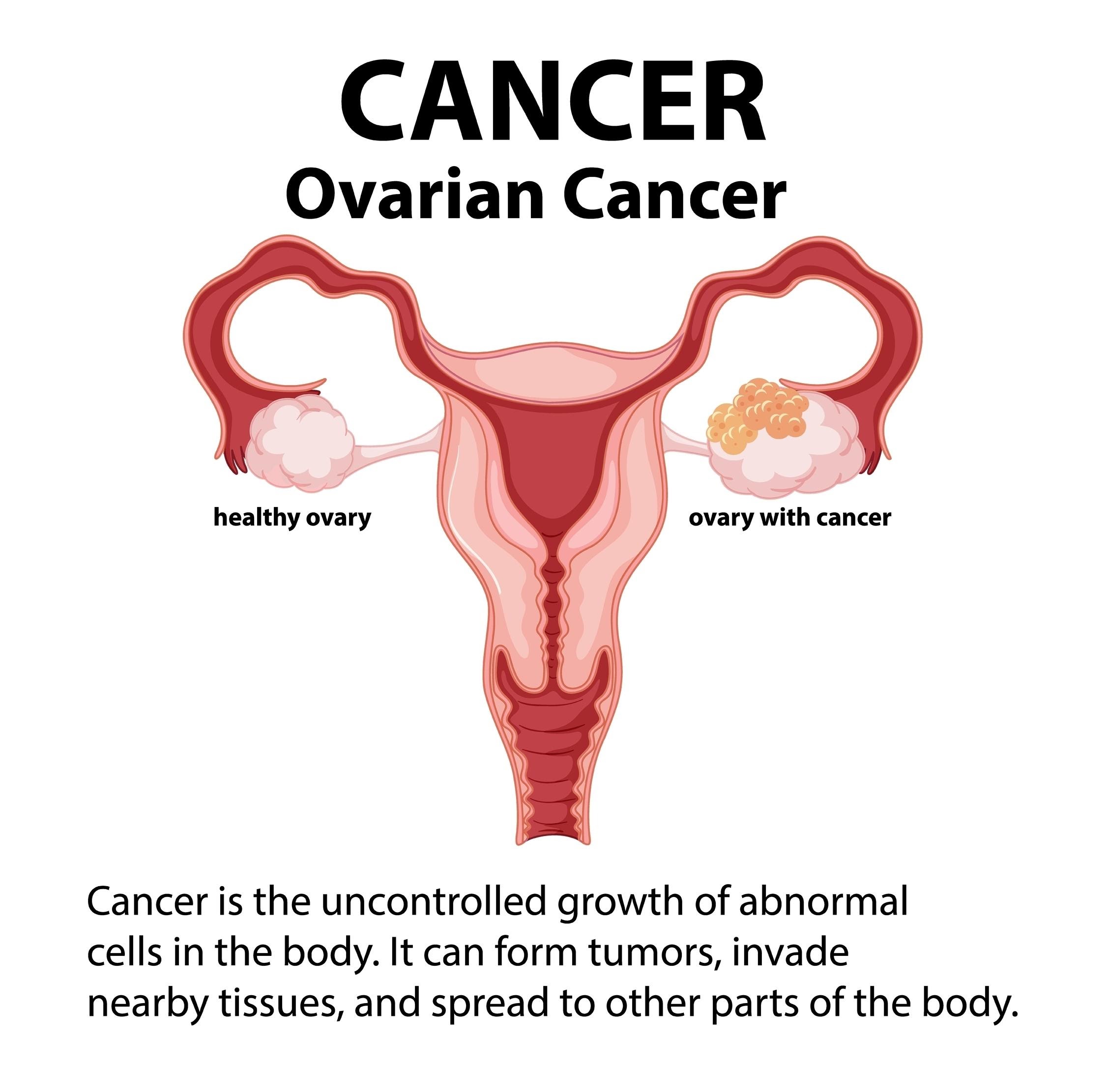 Ovarian Cancer