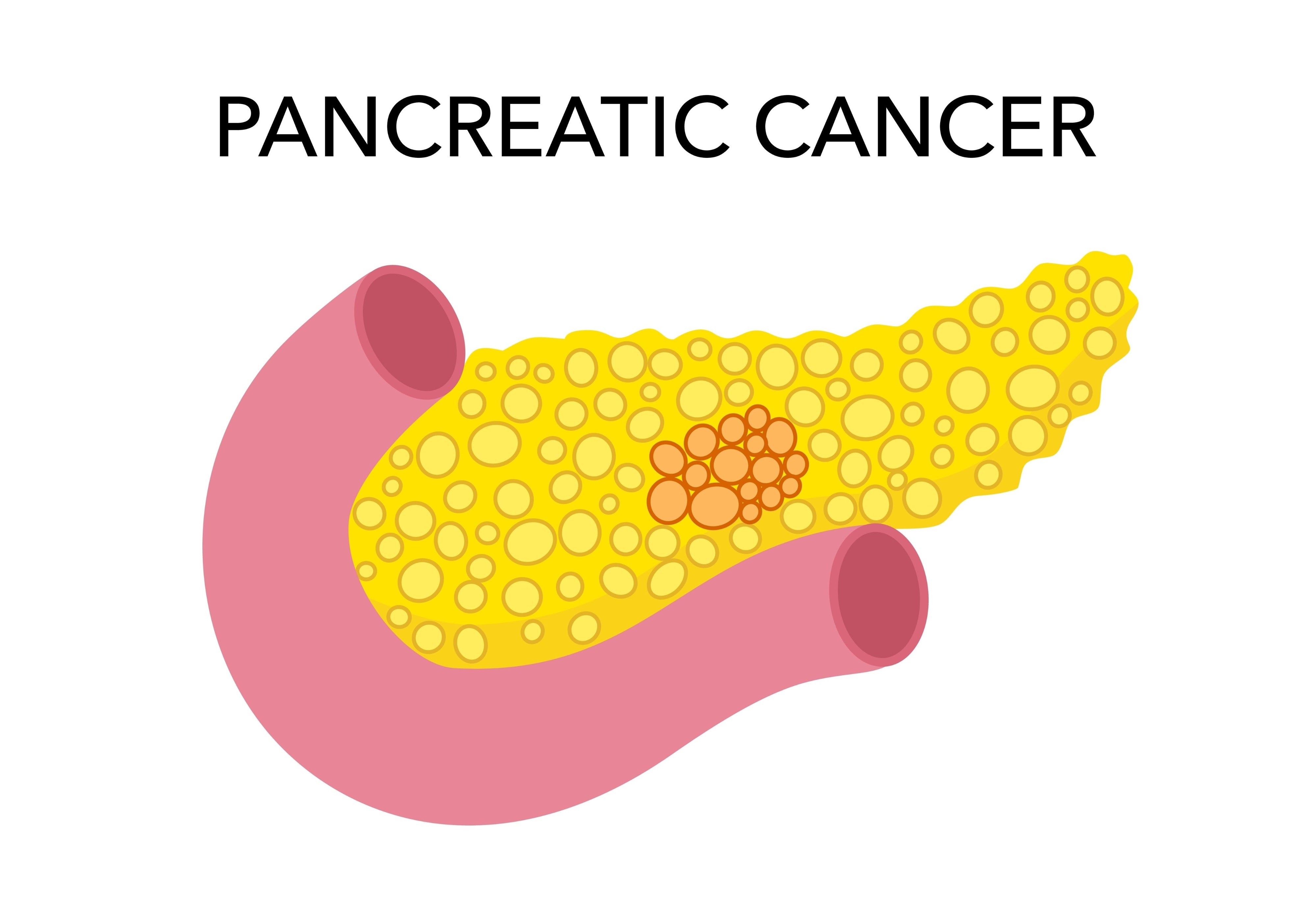 Pancreatic Cancer