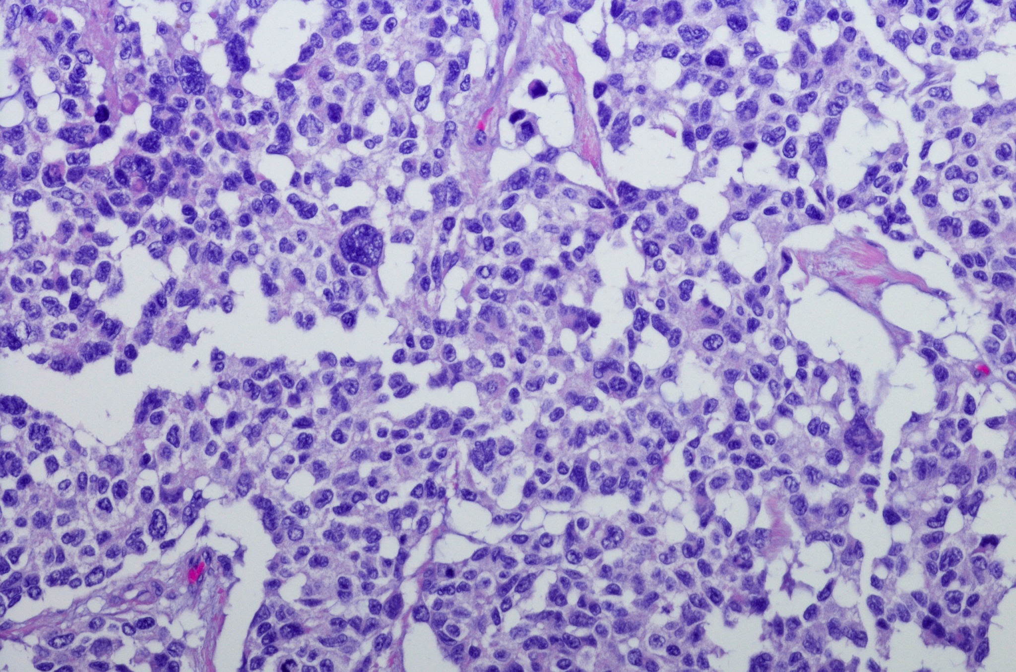 Rhabdomyosarcoma
