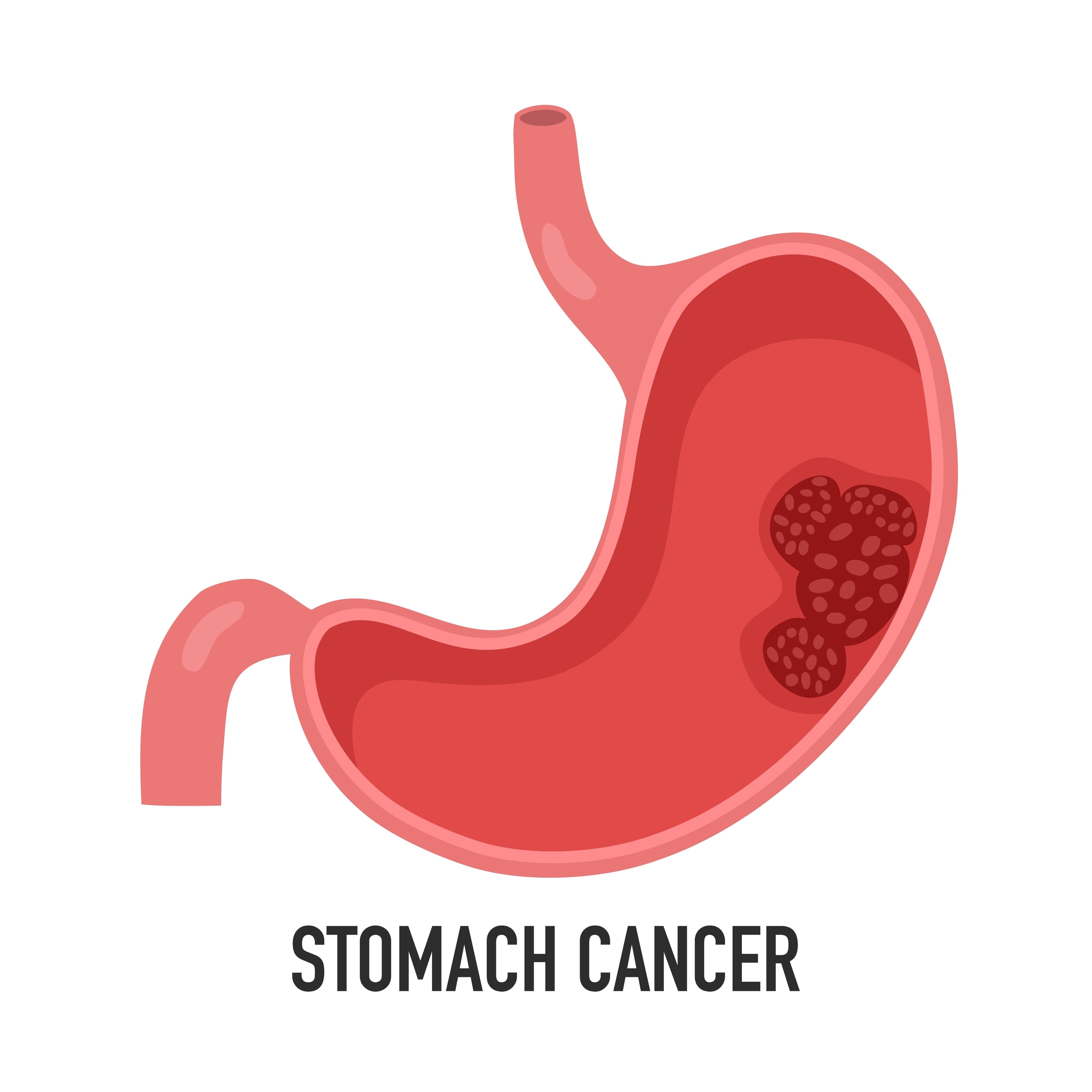 Stomach (Gastric) Cancer