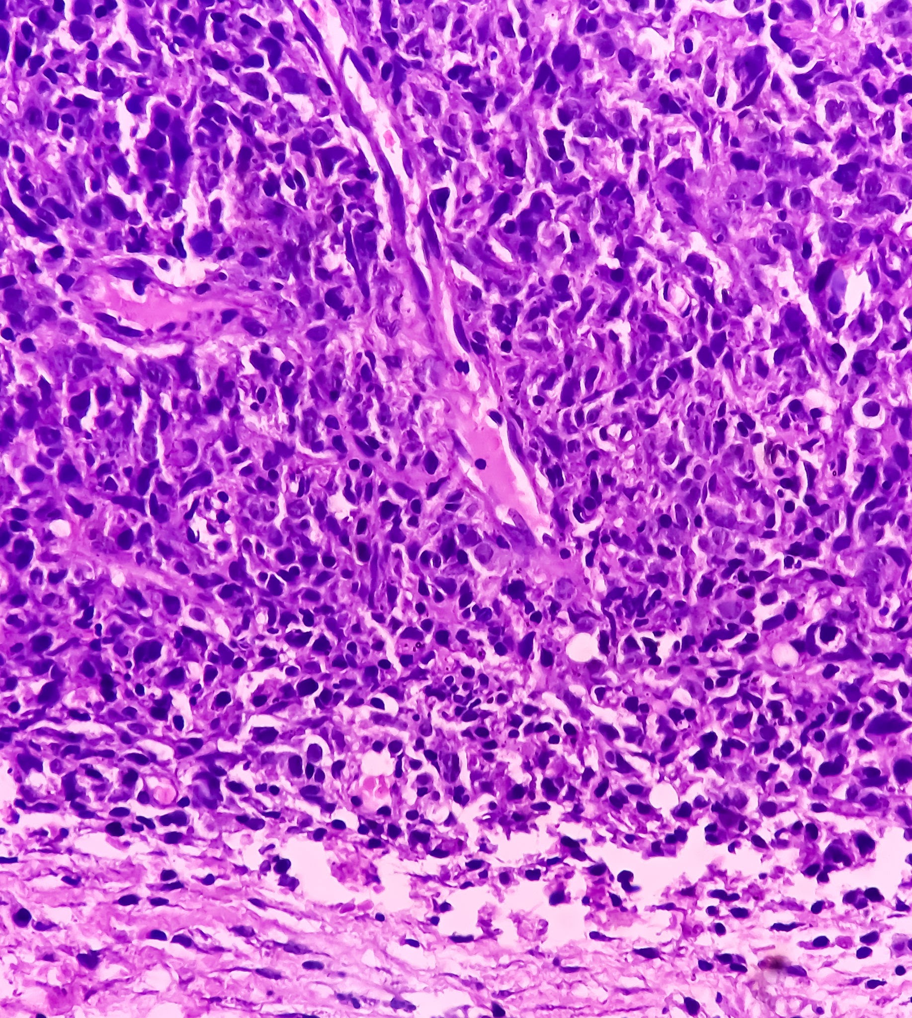 Undifferentiated Pleomorphic Sarcoma