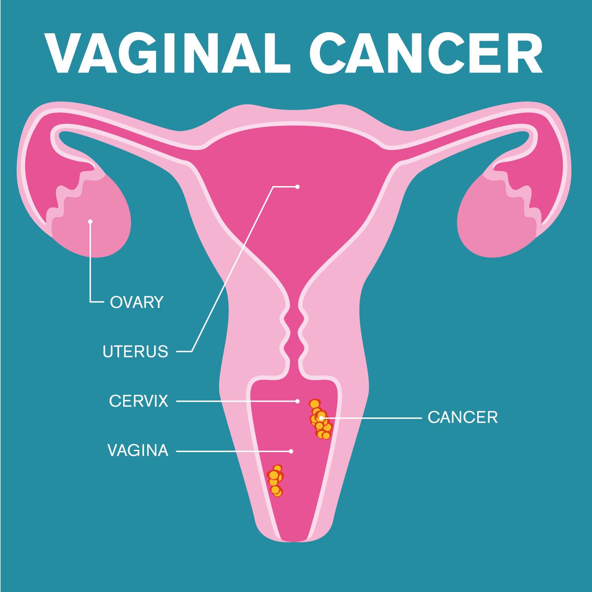 Vaginal Cancer