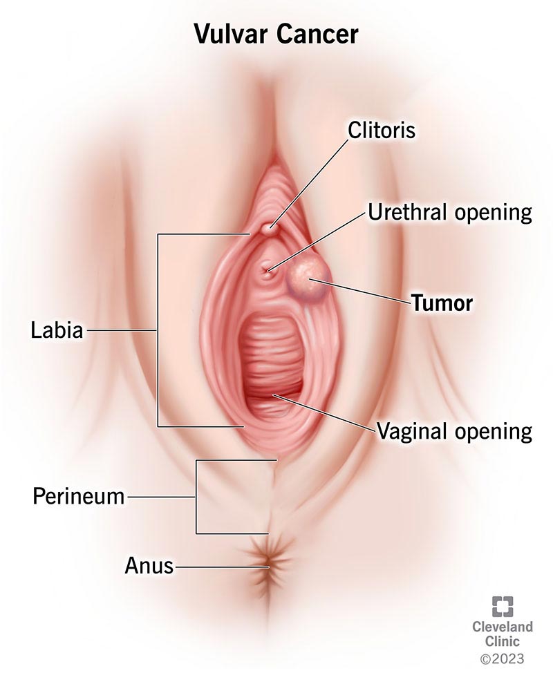 Vulvar Cancer